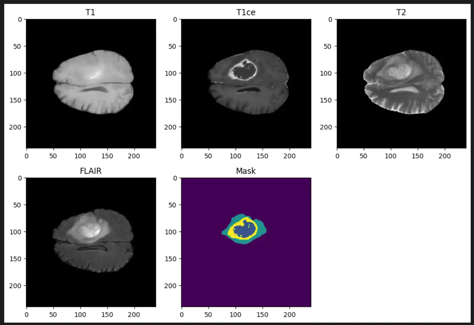 Four individual brain MRI scans showing T1, T1ce, T2, and FLAIR modalities alongside a combined colored Mask